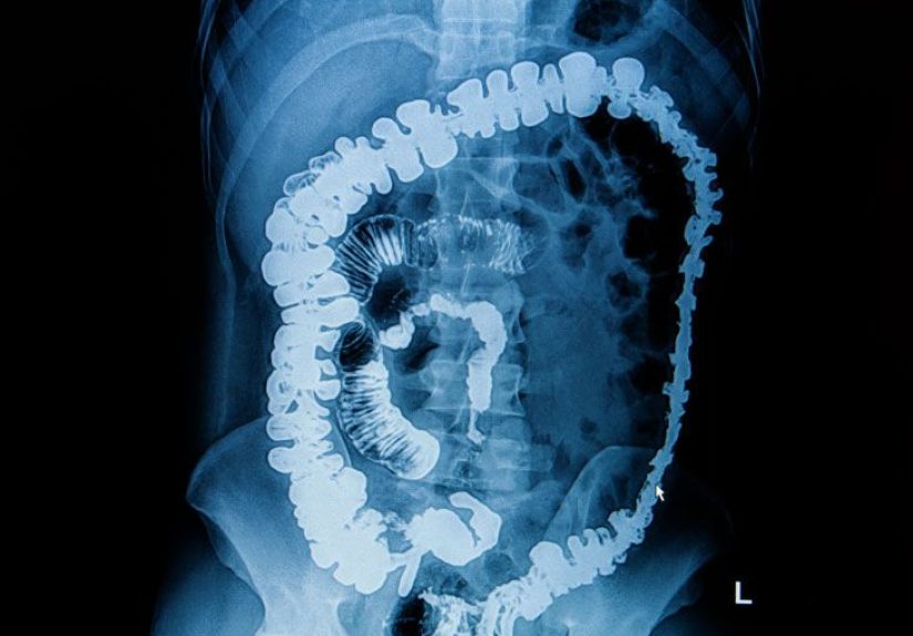 Barium Enema: Purpose, Procedure & Risks