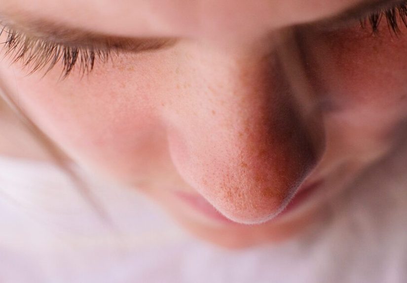 Blackheads vs. Whiteheads: What’s the Difference?