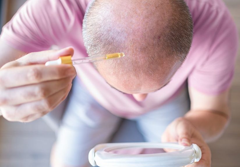 Does Melatonin Cause Hair Loss? What Research Shows