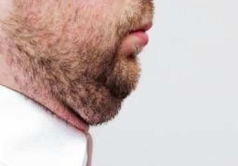 Double chin: Causes and treatment