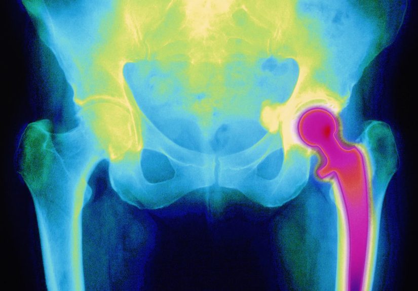 Hip Replacement: What to Know