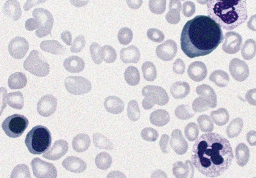 Polycythemia vera life expectancy: With treatment and more