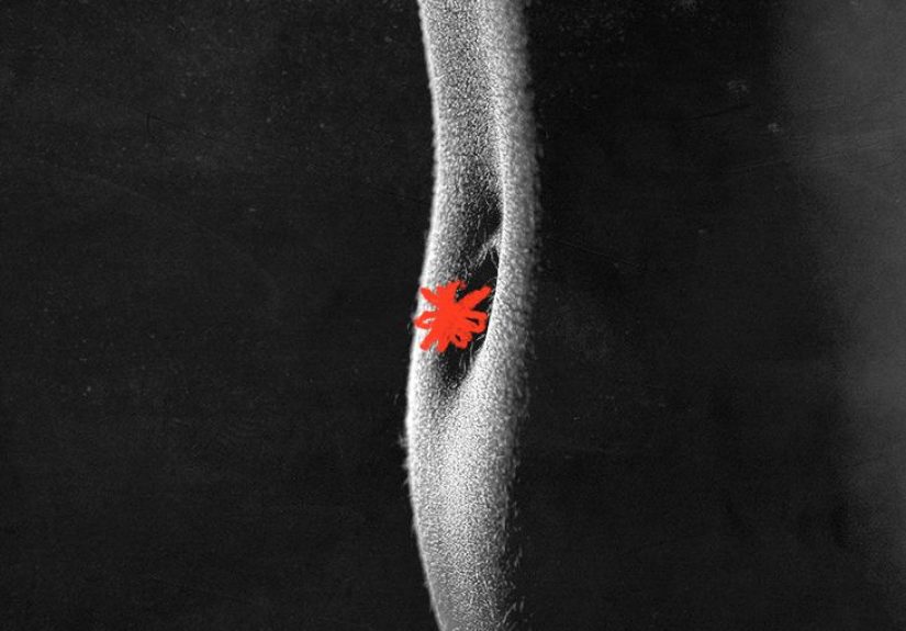 Psoriasis in the belly button: What to know, treatments, and more