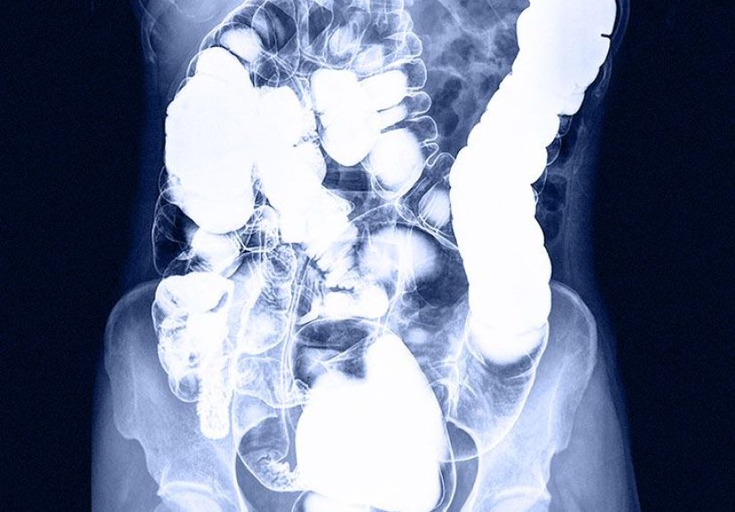 Ulcerative colitis enema: Uses, types, and more