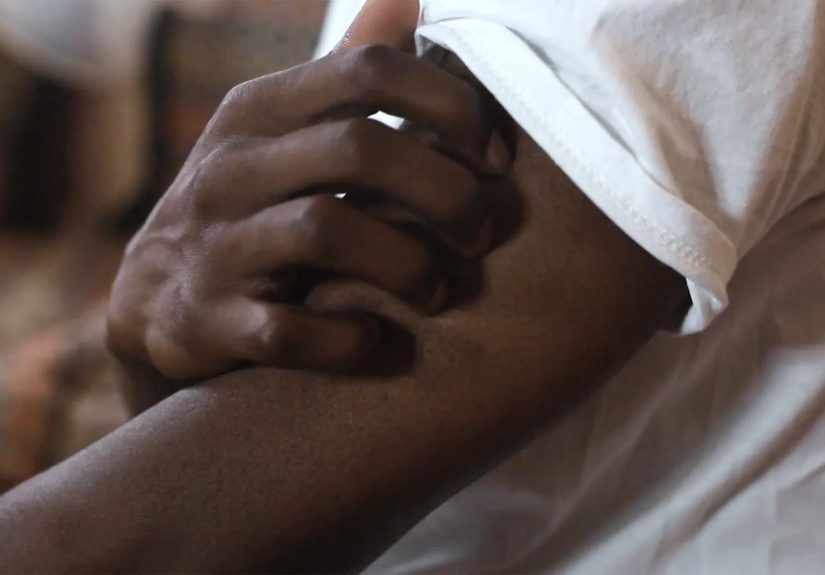 Alternative Treatments for Chronic Spontaneous Urticaria, or Hives