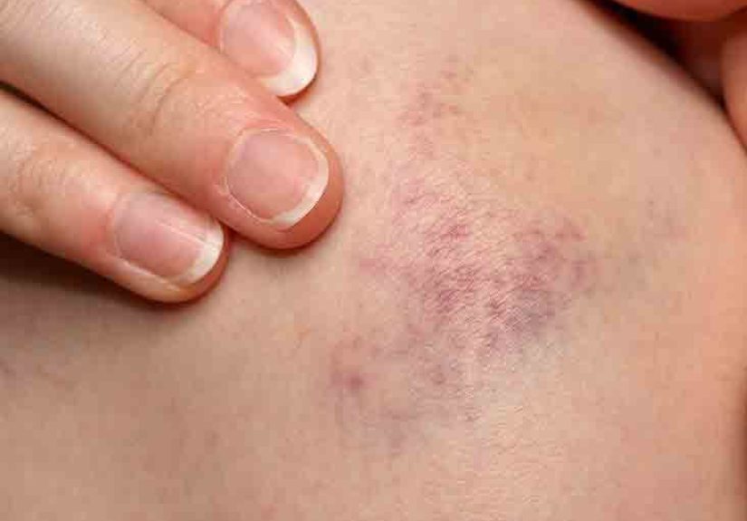 Bleeding Into the Skin: Causes, Diagnosis, Treatments