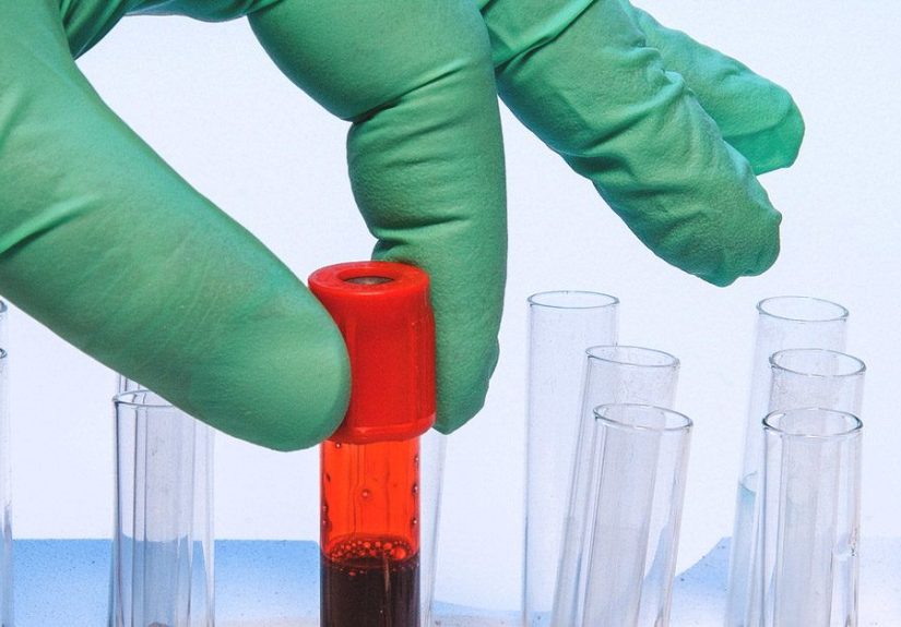 Catecholamine Blood Test: Purpose, Procedure and Preparation