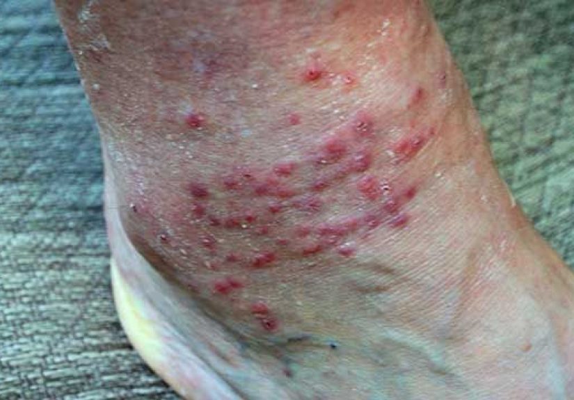 Chigger Bites: What They Look Like, Treatment, and More