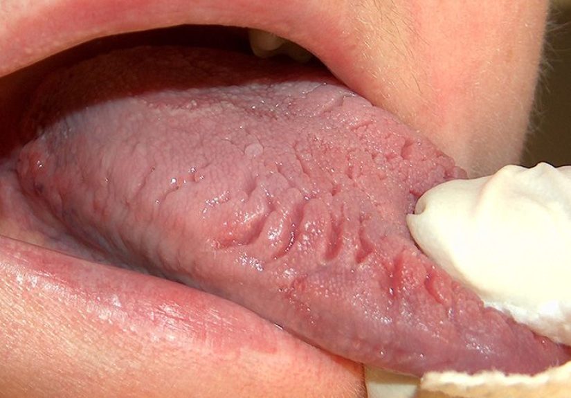 Cracked tongue: Definition, causes, symptoms, and treatment