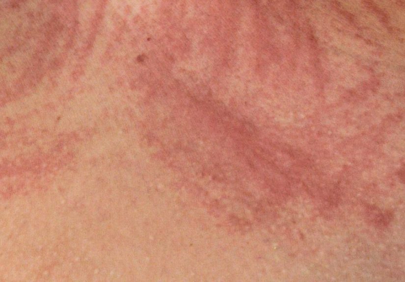 Dermatographia: Symptoms, Causes, Treatment, and More