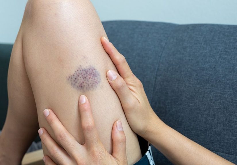 Hemophilia and Bruising: Causes, Diagnosis, and Treatment