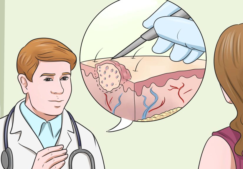 How to Get Rid of Warts on Hands: 13 Steps