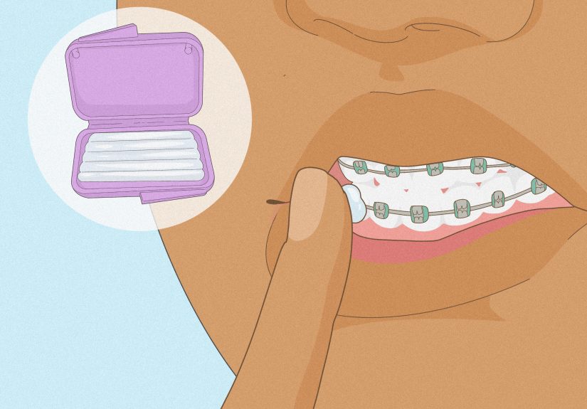 How to Soothe the Pain of New or Tightened Braces: Easy Tips