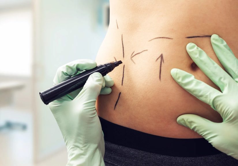 Liposuction: How It Works, Types, Safety, Side Effect & Benefits