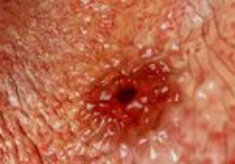 Peptic Ulcer: Causes, Treatment, and Prevention