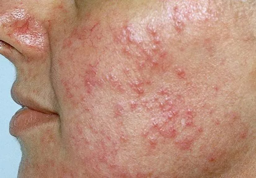 Rosacea or Something Else?