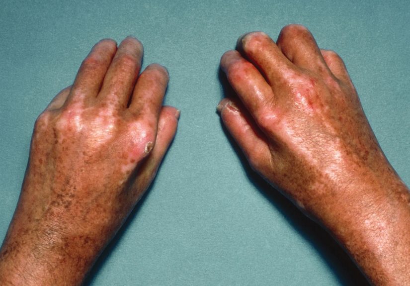 Scleroderma: Causes, Symptoms, and Treatment