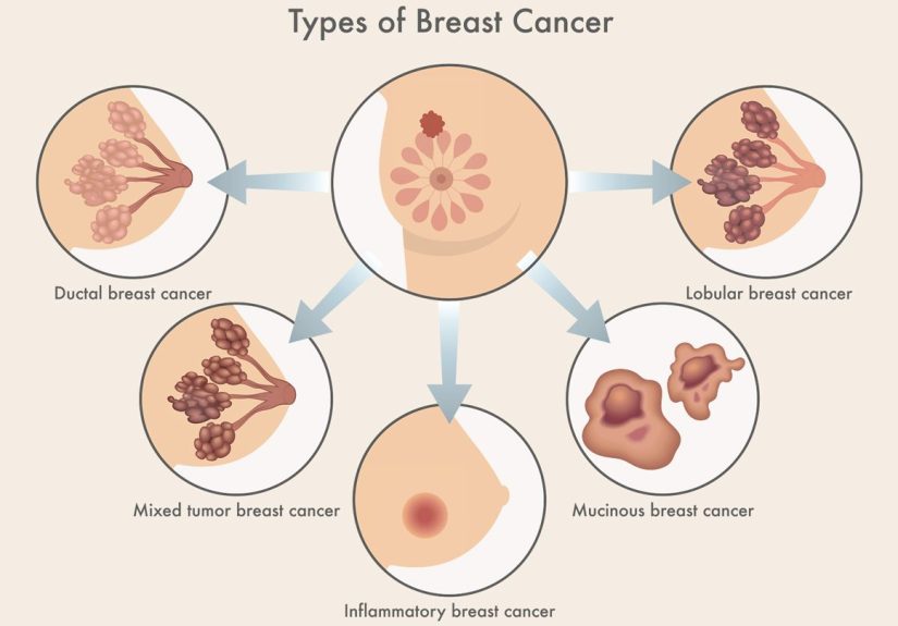 Understanding Different Types of Breast Cancer