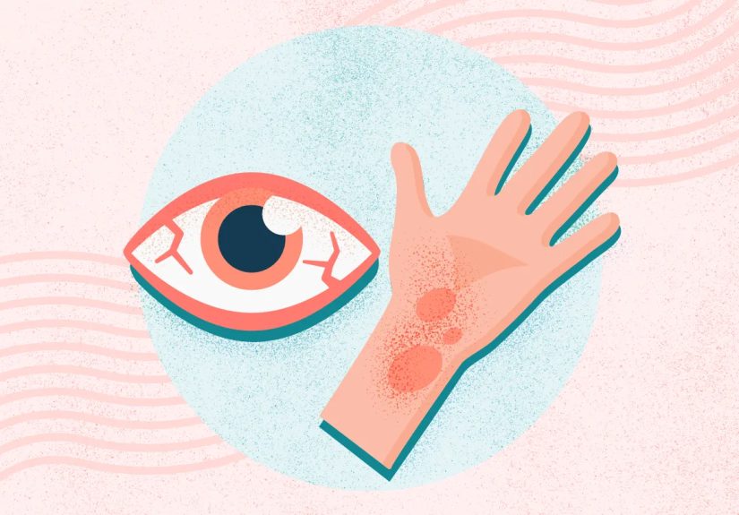 What Are Allergies? Symptoms, Causes, Diagnosis, Treatment, and Prevention