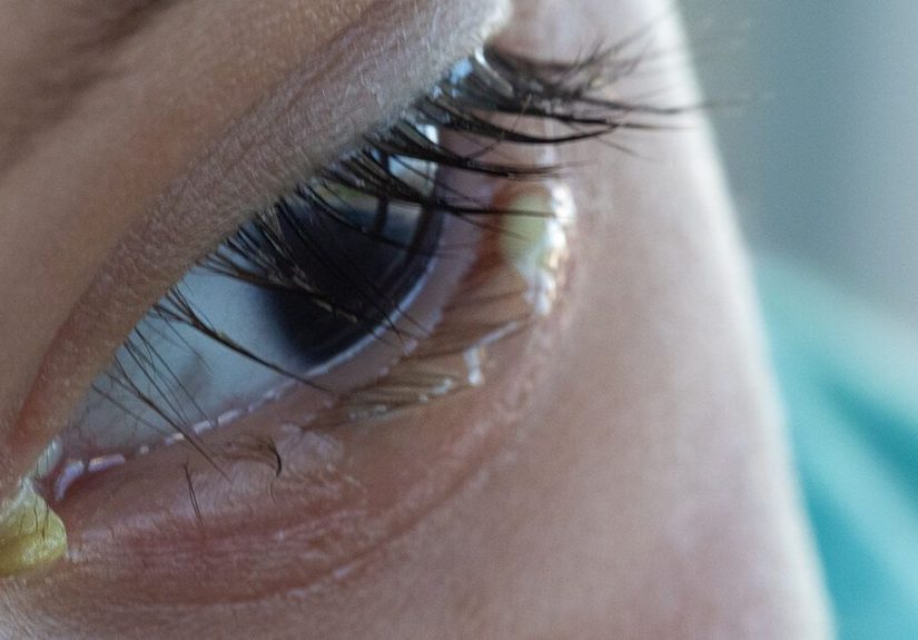 What Causes Crusty Dry Eye Discharge?