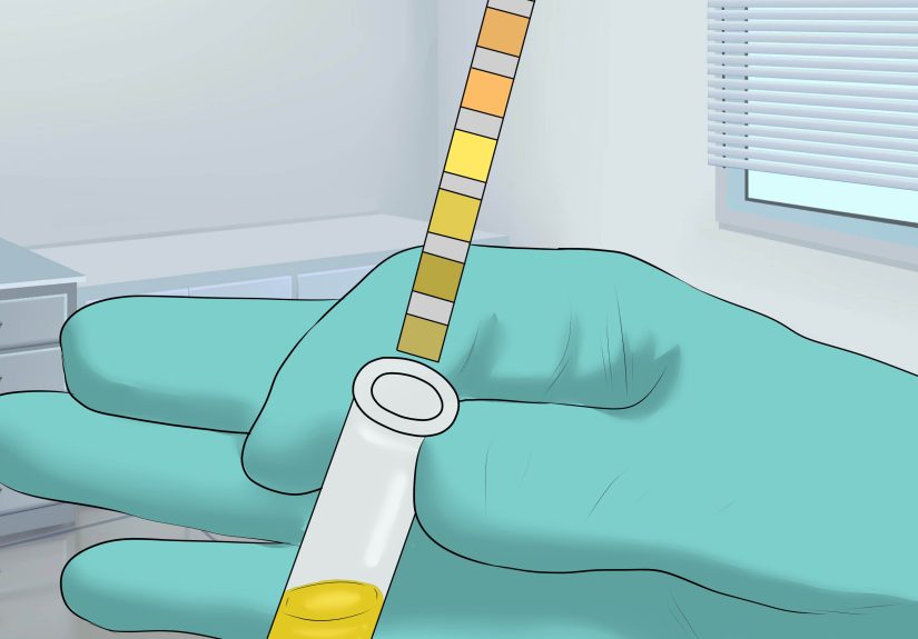 3 Ways to Pass a Kidney Stone Fast