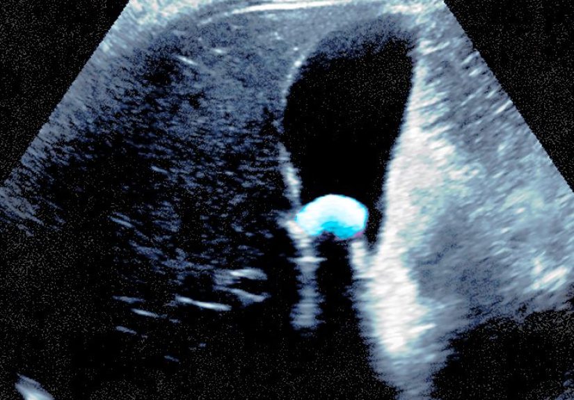 Gallstones: Treatments, Symptoms, and Causes