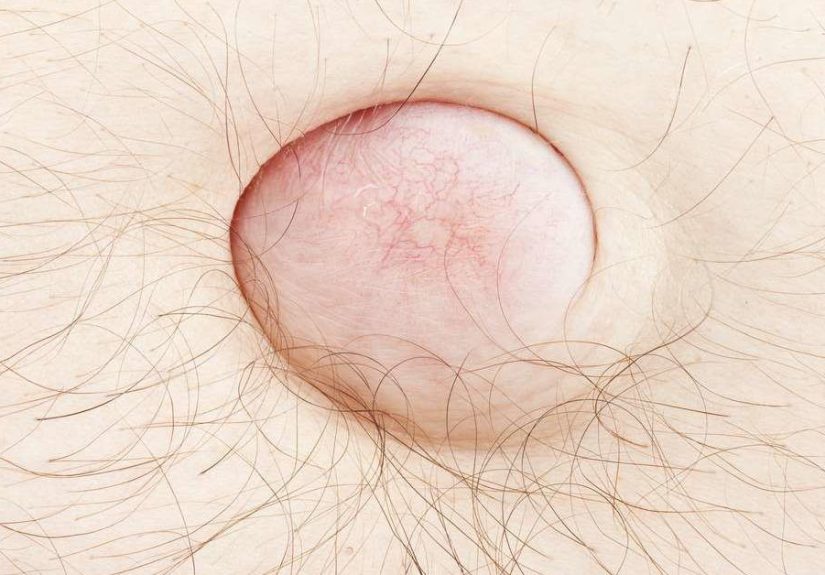 Hernia: Causas, tratamientos y diagnóstico