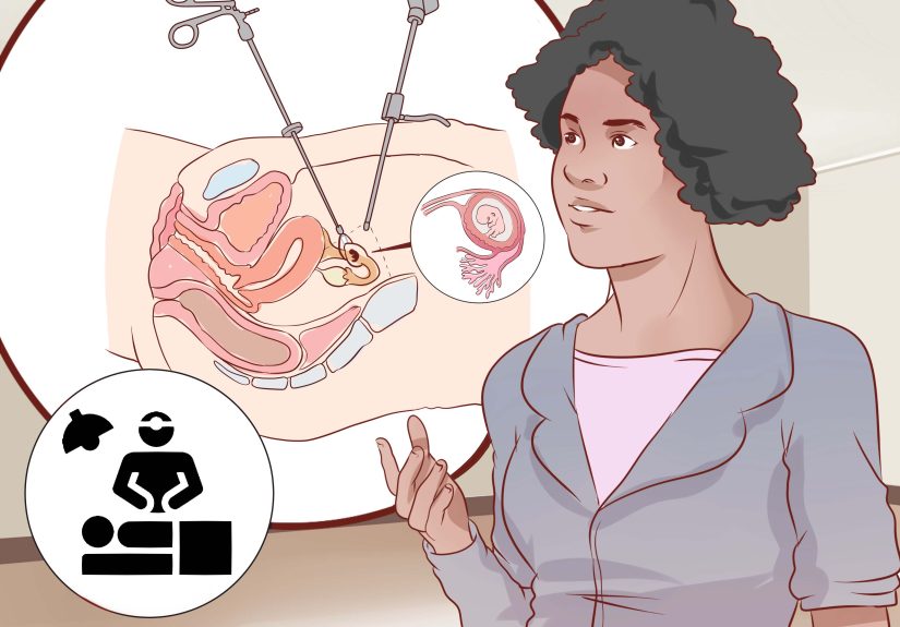 How to Detect an Ectopic Pregnancy: Advice from a Surgeon