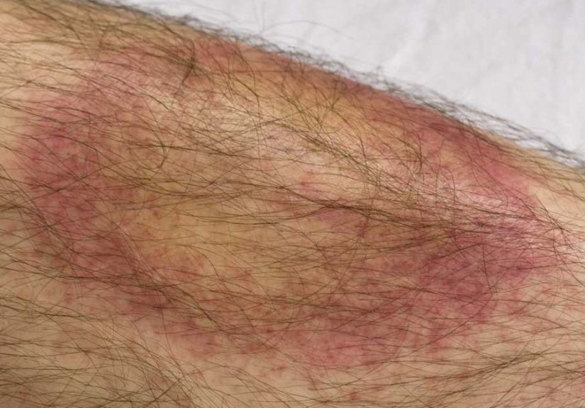 Lyme disease: Symptoms, transmission, and treatment