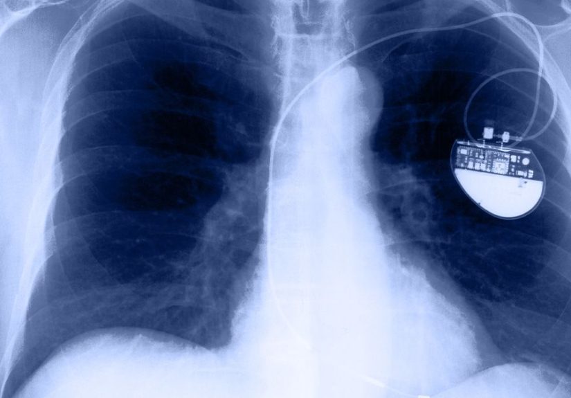 Pacemaker for heart failure: Who can benefit and how do they work?