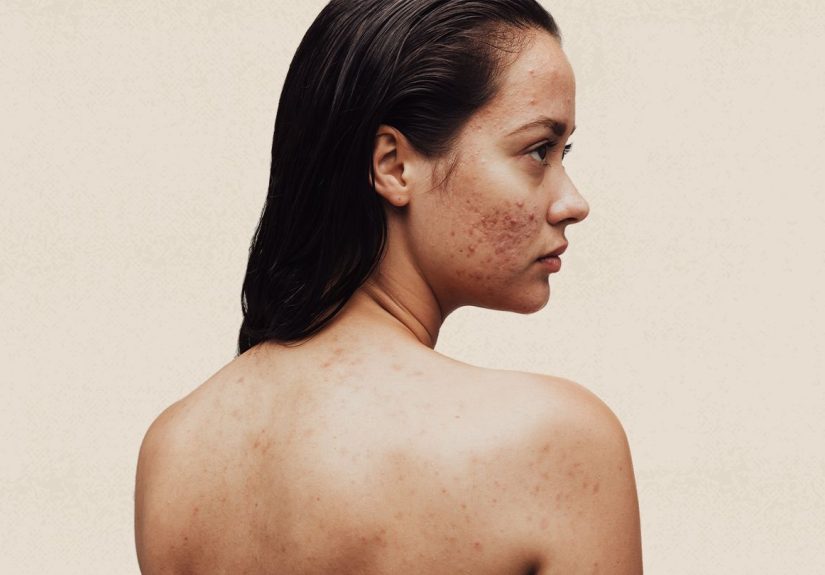Acne Is Common, But Carries a Heavy Emotional Burden