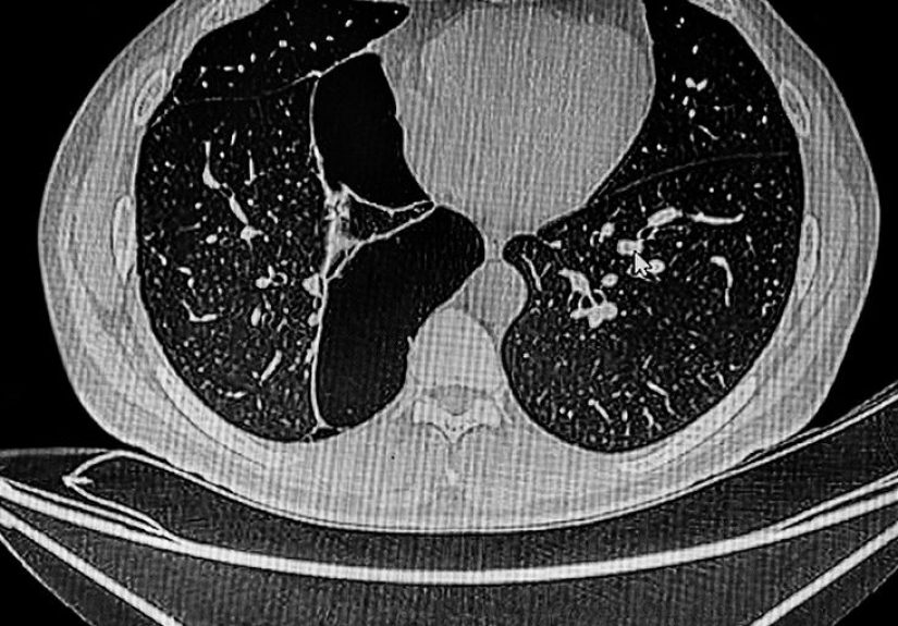 Bullous Emphysema: Symptoms, Outlook, Treatment, and More