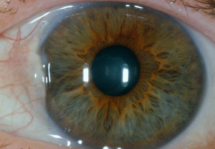 Bumps on Eyeball: Causes, Types, and Treatment