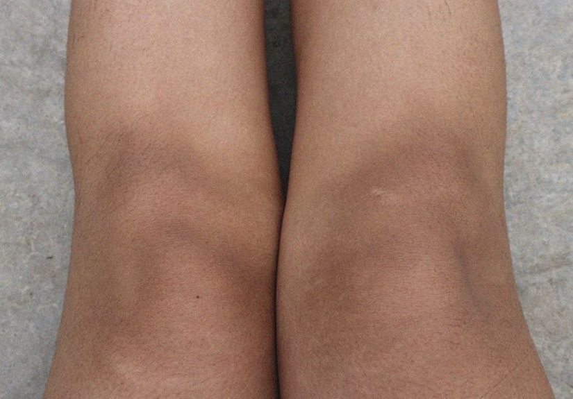Dark Knees: Causes and Home Treatment