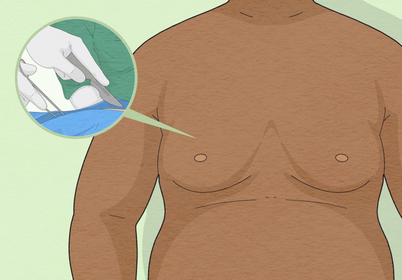 Detecting Gynecomastia: Symptoms, Causes, and Treatments