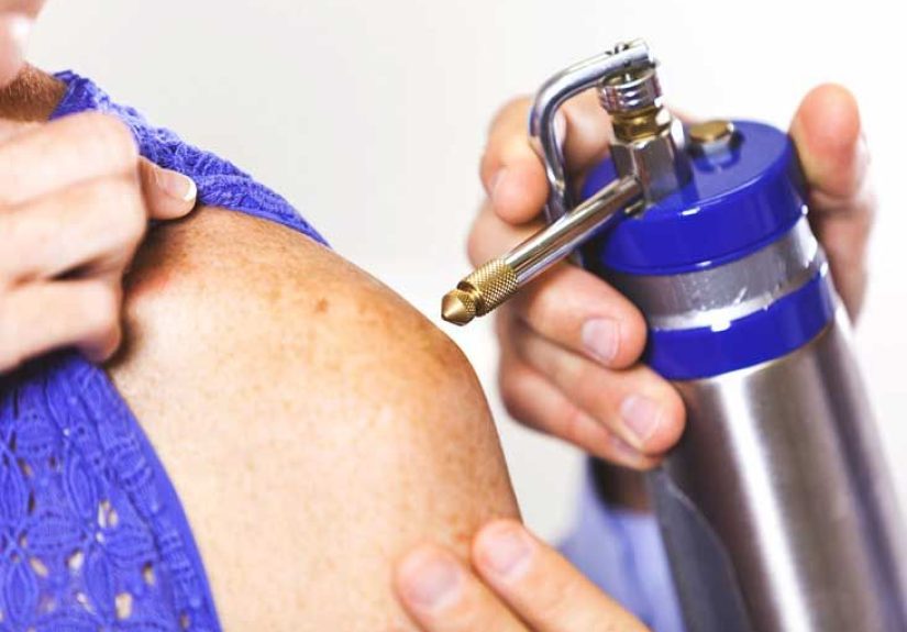 Freezing Warts: Efficacy, What to Expect, and More