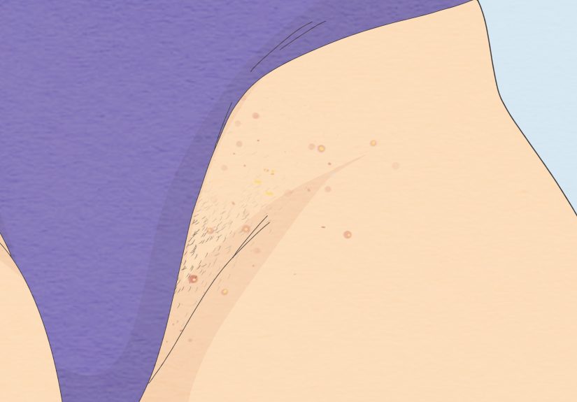 How to Get Rid of Fordyce Spots: 12 Steps