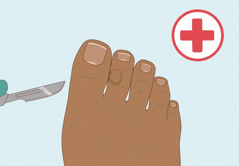 How to Remove Corns from Your Toes: 12 Steps