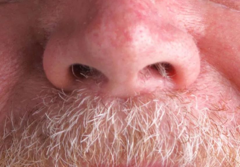 Nose Hair: Why We Have Them and How to Get Rid of Them